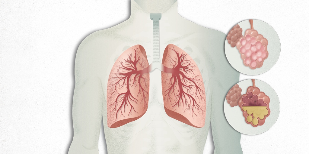 Pneumonia symptoms, reasons and treatment